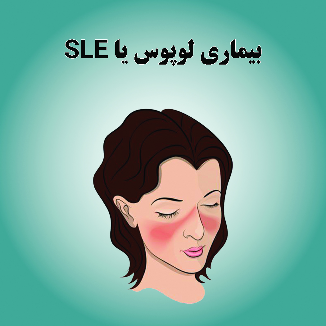 بیماری لوپوس