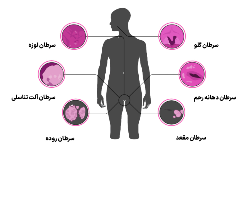 ویروس پاپیلومای انسانی یا اچ پی وی (HPV)، یکی از شایع‌ترین عفونت‌های منتقله از راه جنسی در جهان است که می‌تواند موجب بروز زگیل تناسلی و انواعی از سرطان‌ها مانند سرطان دهانه رحم، گلو، مقعد و دیگر بخش‌های بدن شود. آشنایی با اچ پی وی و راه‌های پیشگیری از آن می‌تواند تأثیر چشمگیری در کاهش خطرات این بیماری داشته باشد.