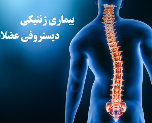 عکس شاخص دیستروفی عضلانی