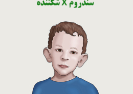 سندروم ایکس شکننده