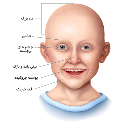 علائم بیماری پروجریا (پیری زودرس) - شرکت درمان نگار آیندگان
