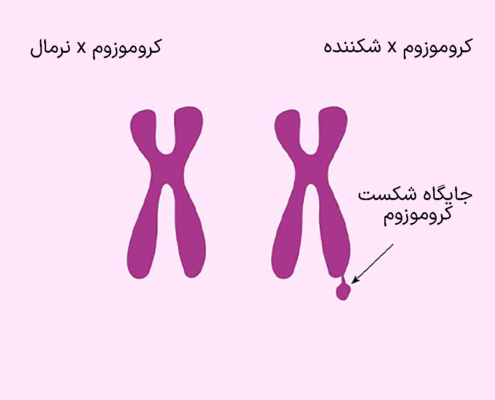 کروموزوم x شکننده.