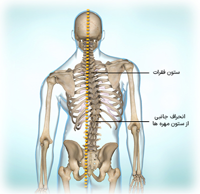 بیماری ارثی آتاکسی فردریش