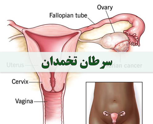 علت و علائم سرطان تخمدان در زنان - شرکت درمان نگار آیندگان