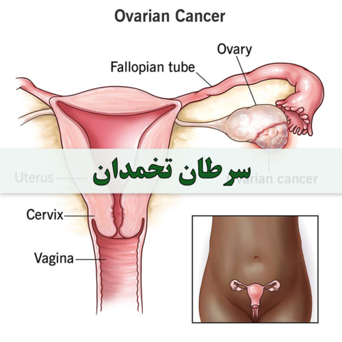 علت و علائم سرطان تخمدان در زنان - شرکت درمان نگار آیندگان