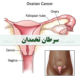 علت و علائم سرطان تخمدان در زنان - شرکت درمان نگار آیندگان