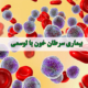 بیماری سرطان خون یا لوسمی - شرکت درمان نگار آیندگان