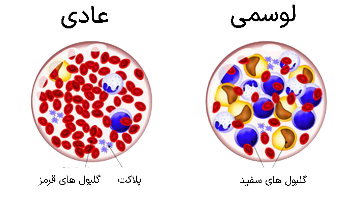 لوسمی یا سرطان خون