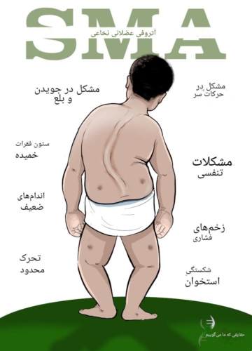 بیماری اتروفی عضلانی و نخاعی