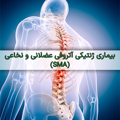 بیماری SMA - درمان نگار آیندگان