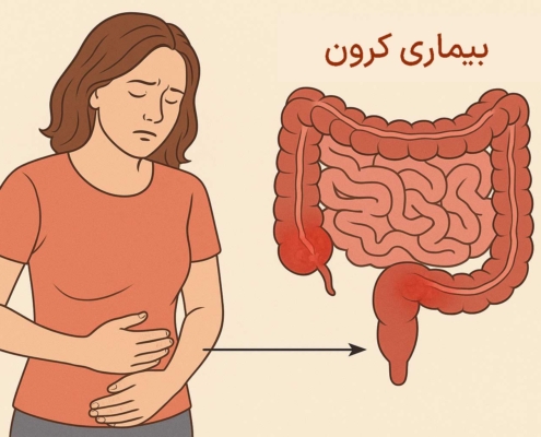 بیماری کرون - درمان نگار آیندگان